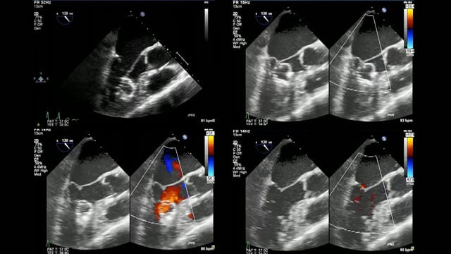 Complications of LAA closure - Avoidance and management