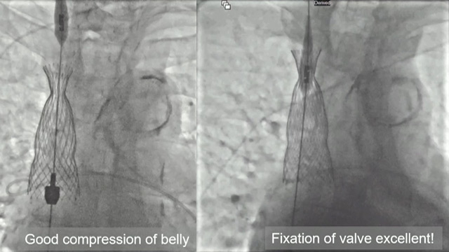Cracking the tricuspid code 'the Bicaval revolution'
