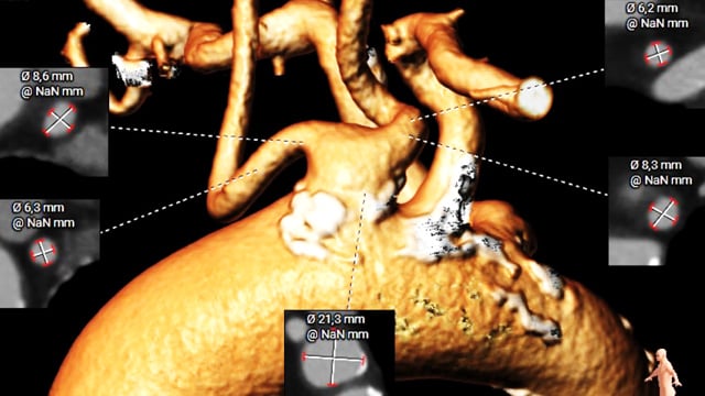 Curious TAVI scenarios: solving complex anatomical and technical pitfalls