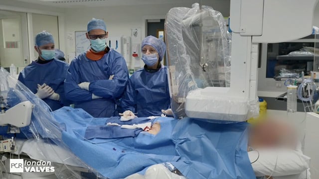 Exceptional engineering, predictable outcomes - Latest development of the VitaFlow TAVI device