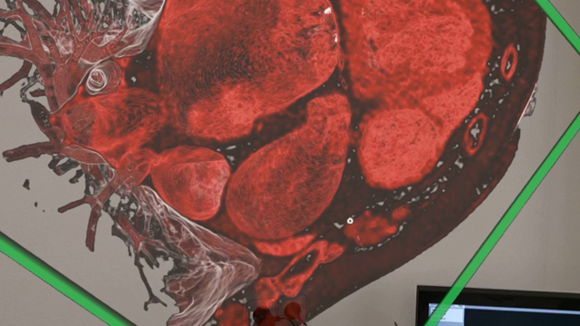 Featured research: innovative solutions for mitral valve repair and replacement