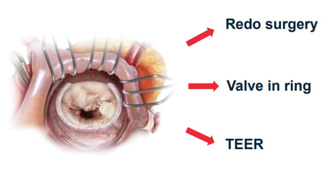 Featured research: latest advances in mitral TEER and valve repair technologies