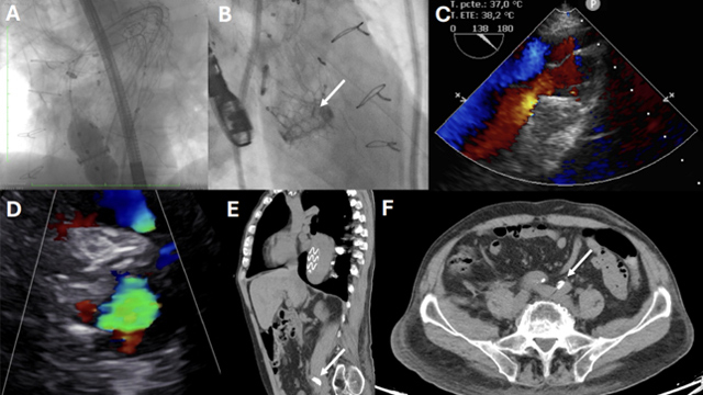 Featured research - TAVI: MELA, ViMech & more