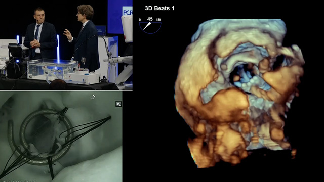 From repair to replacement: a portfolio of options for your mitral and tricuspid regurgitation patients