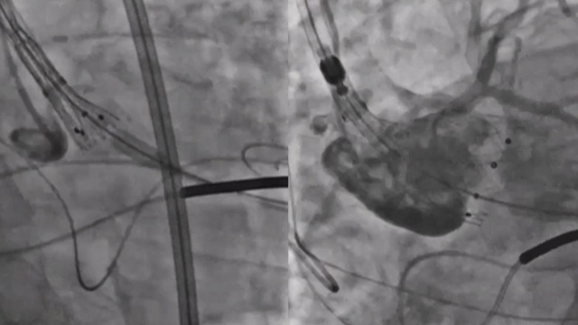 How to optimise TAVI outcomes in extreme patient anatomies?