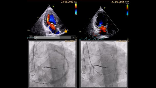 Just CINCH - Indirect annuloplasty for secondary mitral regurgitation in heart failure patients