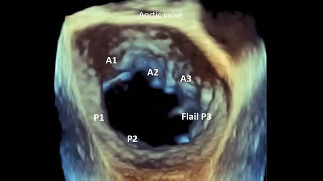 Meet the masters: complex mitral TEER