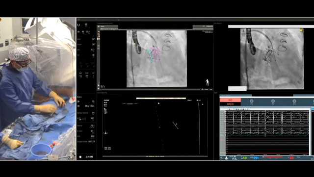 Mitral paravalvular leak closure: procedural planning and step-by-step performance
