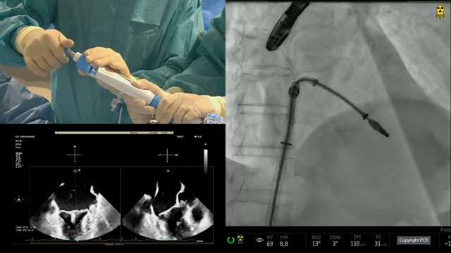 Mitral regurgitation: from guidelines to clinical practice