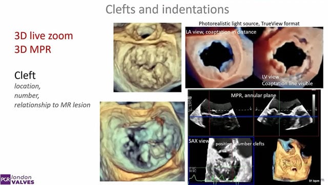Mitral TEER masterclass
