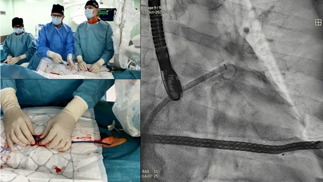 Open design, confident delivery - How a novel LAA closure device provides predictable outcomes in complex anatomical settings