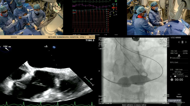 Paravalvular leaks and VSD percutaneous closure - Recorded cases
