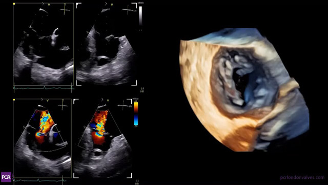 Procedural imaging for tricuspid valve interventions