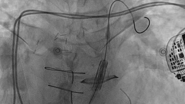 Pulmonary valve interventions