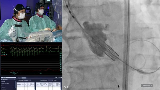 TAVI in 2025: transforming care with the new valvular heart disease guidelines