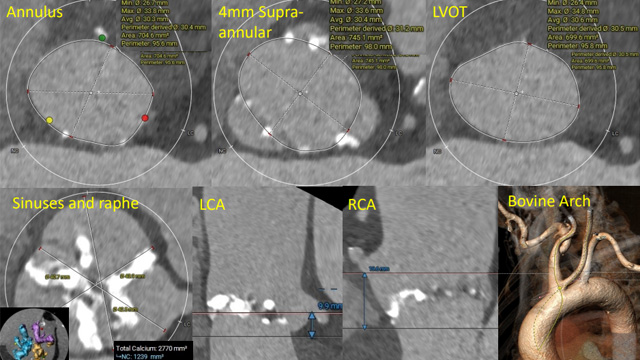 TAVI in bicuspid anatomy