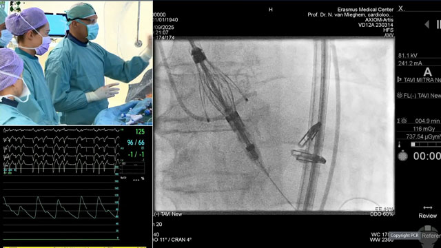 TAVI: LIVE Educational Case from St. Thomas' Hospital - London, UK