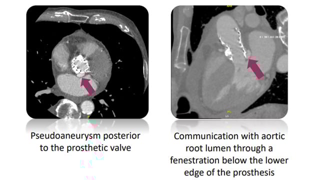TAVI: nightmare in the cathlab - Cardiac arrest, aortic root rupture & duct occluder