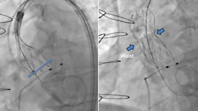TAVI valve-in-valve - Challenging clinical scenarios