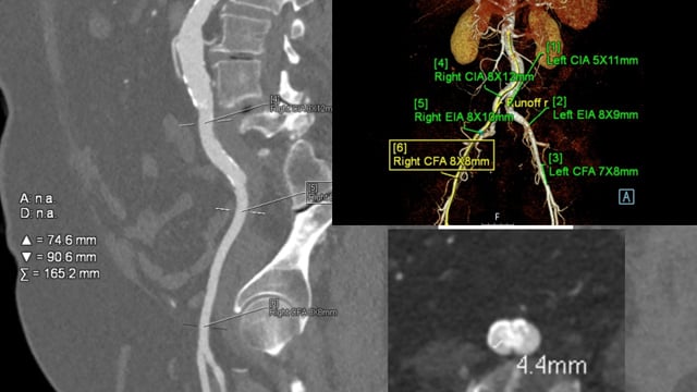 TAVI Valve-in-Valve: Managing unexpected anatomical challenges