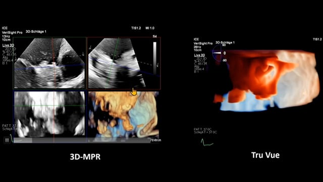 The next frontier in LAA closure: innovations and opportunities