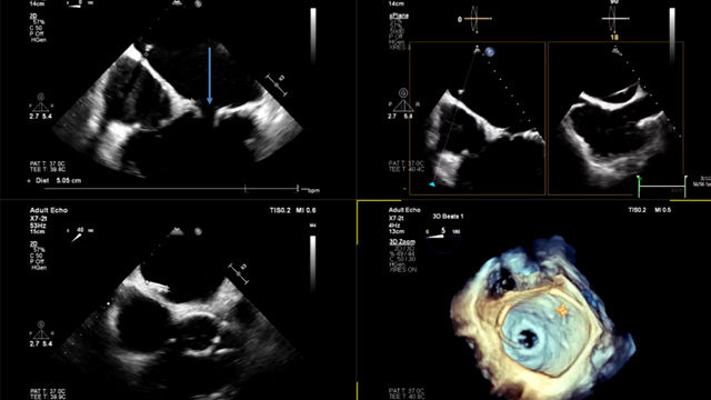Transcatheter mitral valve-in-valve: alternative strategy for optimal alignment
