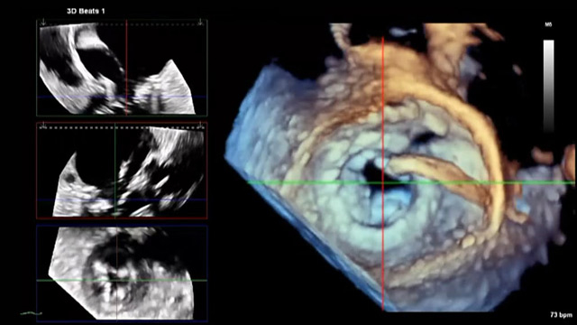 Transcatheter mitral valve-in-valve, valve-in-ring, and valve-in-MAC