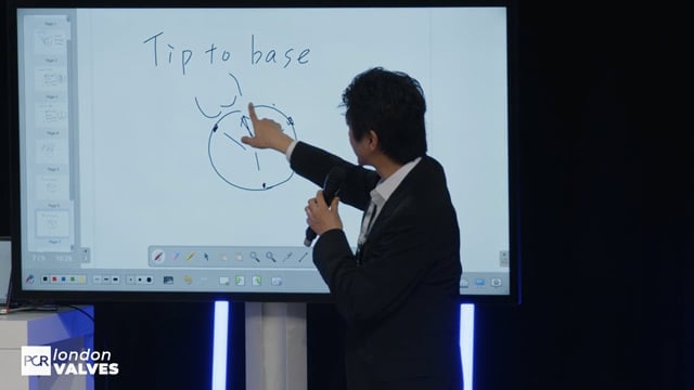 Transcatheter mitral valve replacement in practice