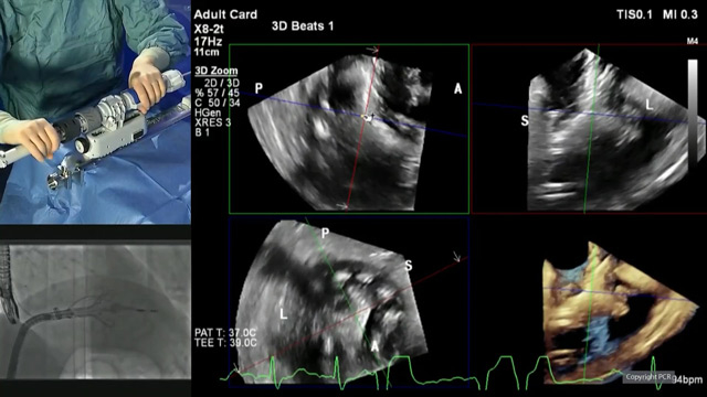 Transcatheter tricuspid valve replacement: LIVE Educational Case from St. Thomas' Hospital - London, UK