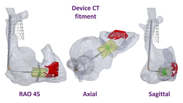 Transcatheter tricuspid valve replacement: pioneering techniques and solutions for high-risk patients