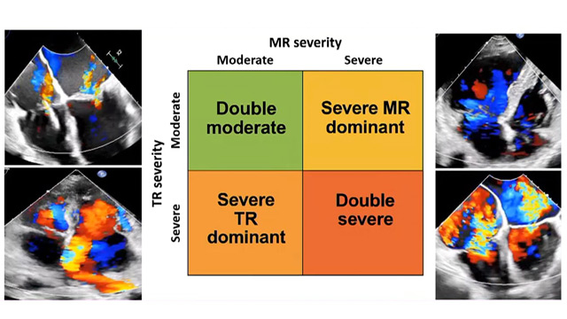 Unravel the complexity of multi-valve disease