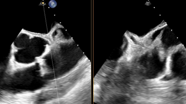 Unusual structural interventions: infective endocarditis, ventricular septal rupture & hypertrophic obstructive cardiomyopathy