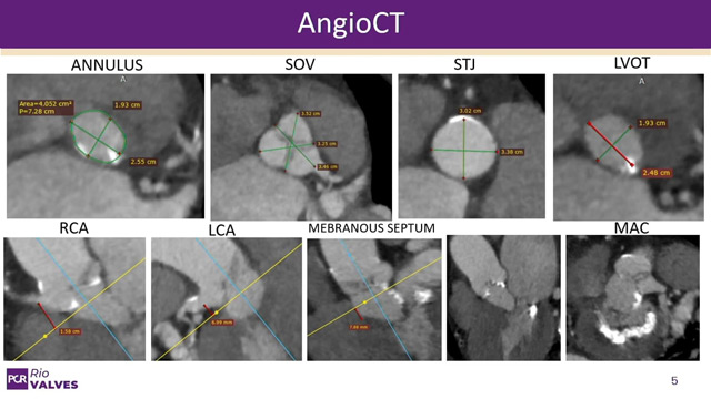Aortic stenosis doesn't play alone: TAVI in multivalvular and coronary artery disease patients