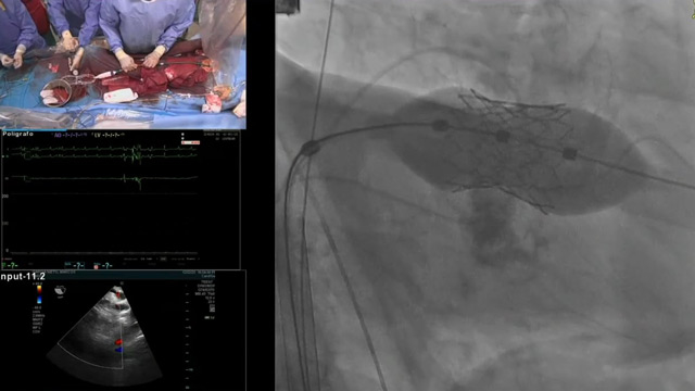 How to optimise outcome in valve-in-valve and valve-in-mitral annular calcification patients
