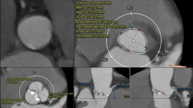 Management of aortic stenosis: what really matters before and after the procedure