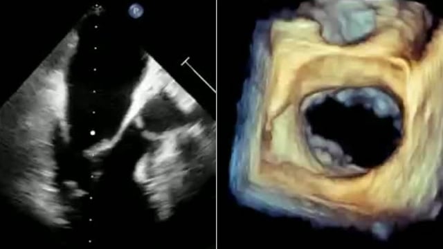 Precision in mitral TEER: LIVE Educational Case from Bordeaux University Hospital - Bordeaux, France