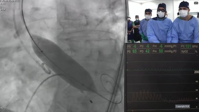 Tailored transfemoral TAVI in complex anatomies - LIVE Case