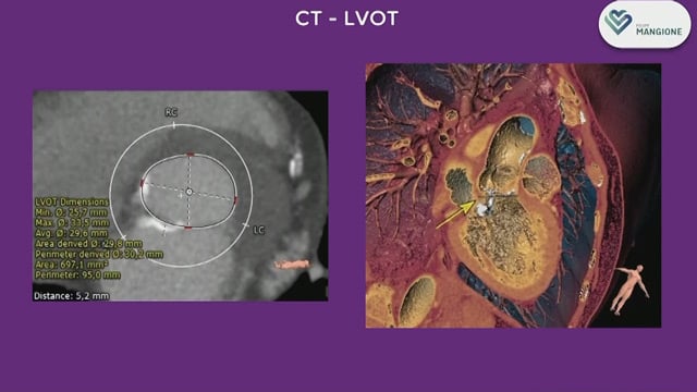 TAVI in challenging scenarios, diving into real-life cases