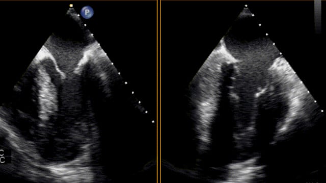 Bicuspid and complications