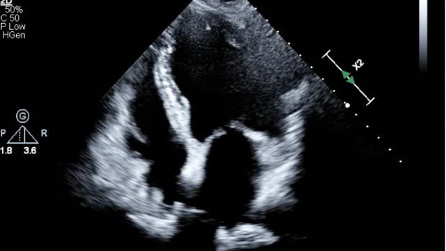 Challenging situations in M-TEER: Takotsubo syndrome