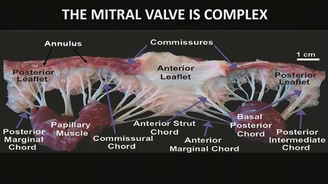Future devices for structural heart interventions