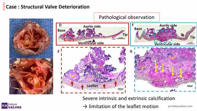 Imaging aortic valve