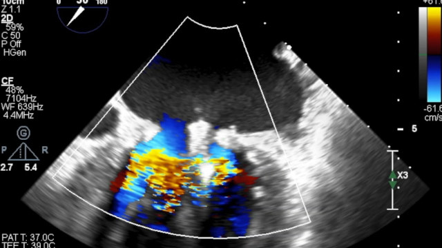 M-TEER difficult situation: small mitral valves, P2 prolapse & leaflet degeneration