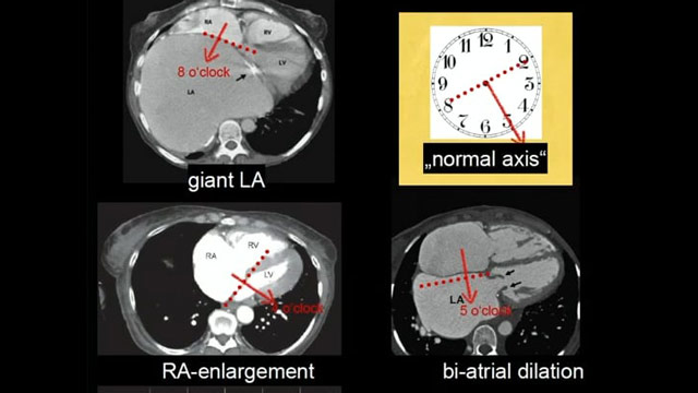 M-TEER for secondary mitral regurgitation