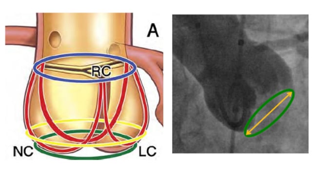 Mastering techniques from basic to complex - Imaging for aortic stenosis
