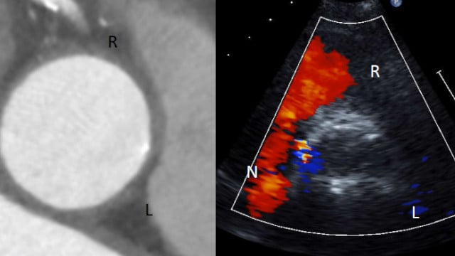 Post-procedure complications: leaflet thrombus, hemolytic anemia & more
