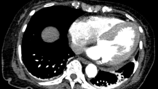 TAVI complications cases: embolized valve, aortic dissection & coronary embolisation