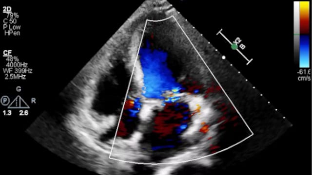 TAVI complications cases: acute decompensated HF, LV perforation & more
