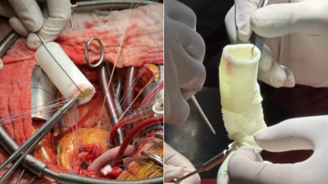 TAVI complications: hemolytic anemia, prosthetic valve endocarditis & stroke
