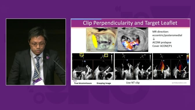 Mastering techniques from basic to complex - TEER for degenerative mitral regurgitation and complex situations